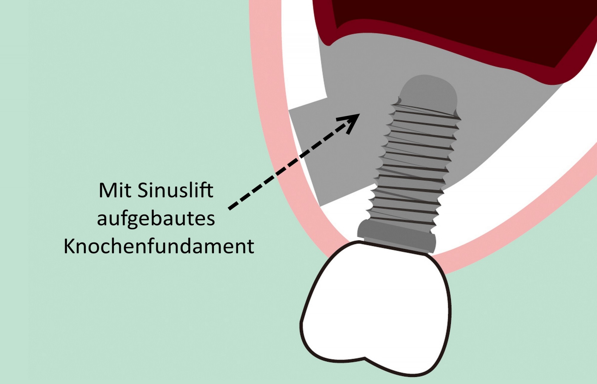 Der schonende Sinuslift zum Knochenaufbau - Aktuelles Item - Dr. Fichna &  Partner | Zahnrzte und Oralchirurgie in Ansbach