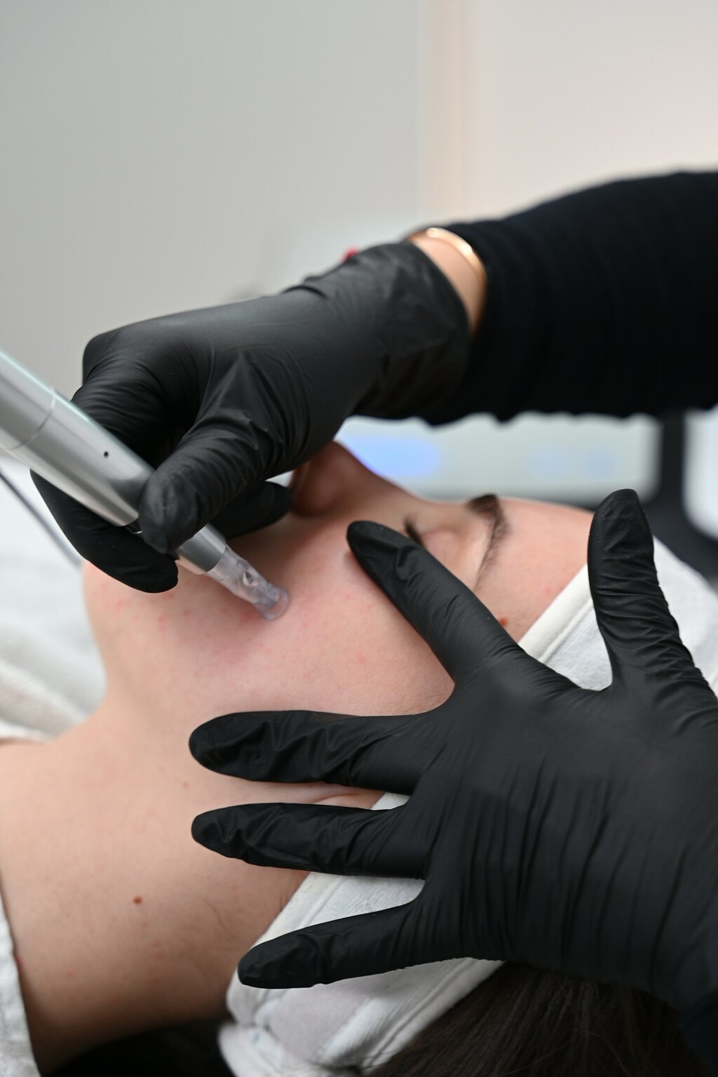 Microneedling  Berlin