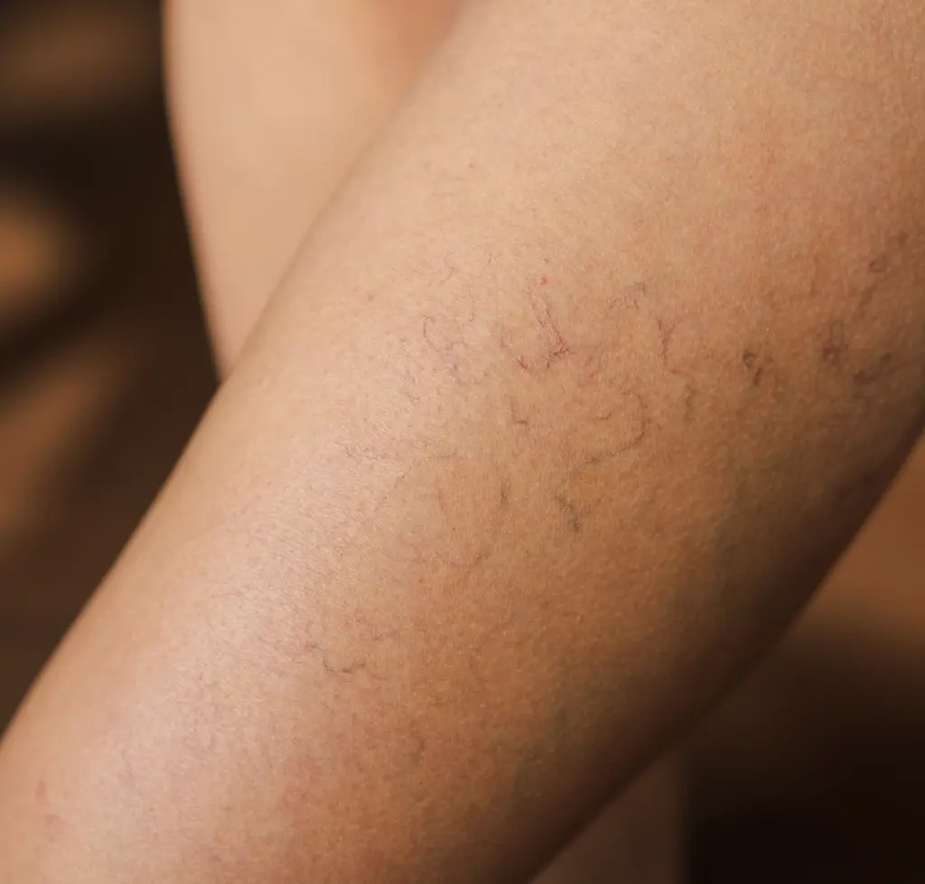 Frauenbeine mit Besenreiser