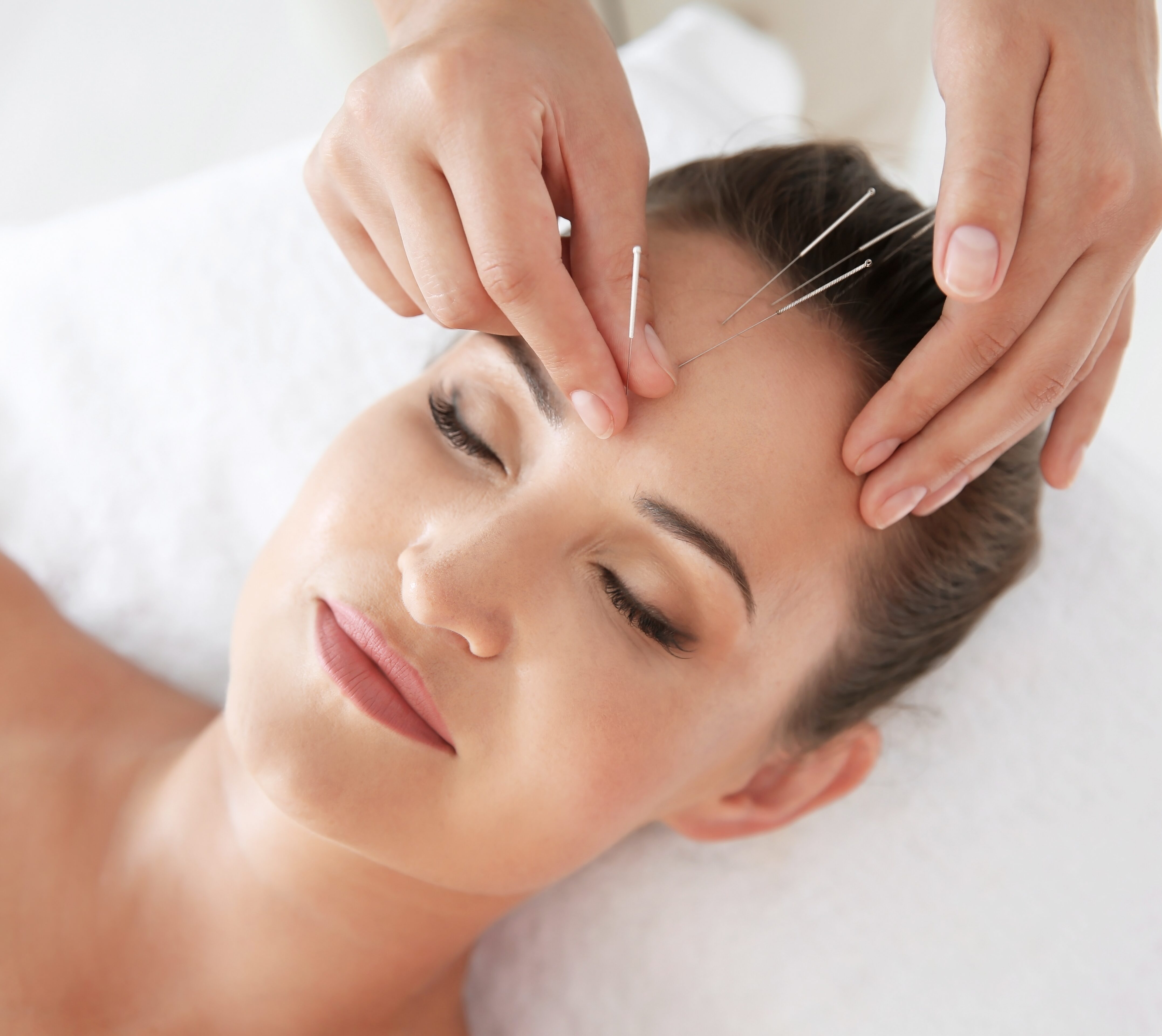 Akupunkturbehandlung an der Stirn einer Frau
