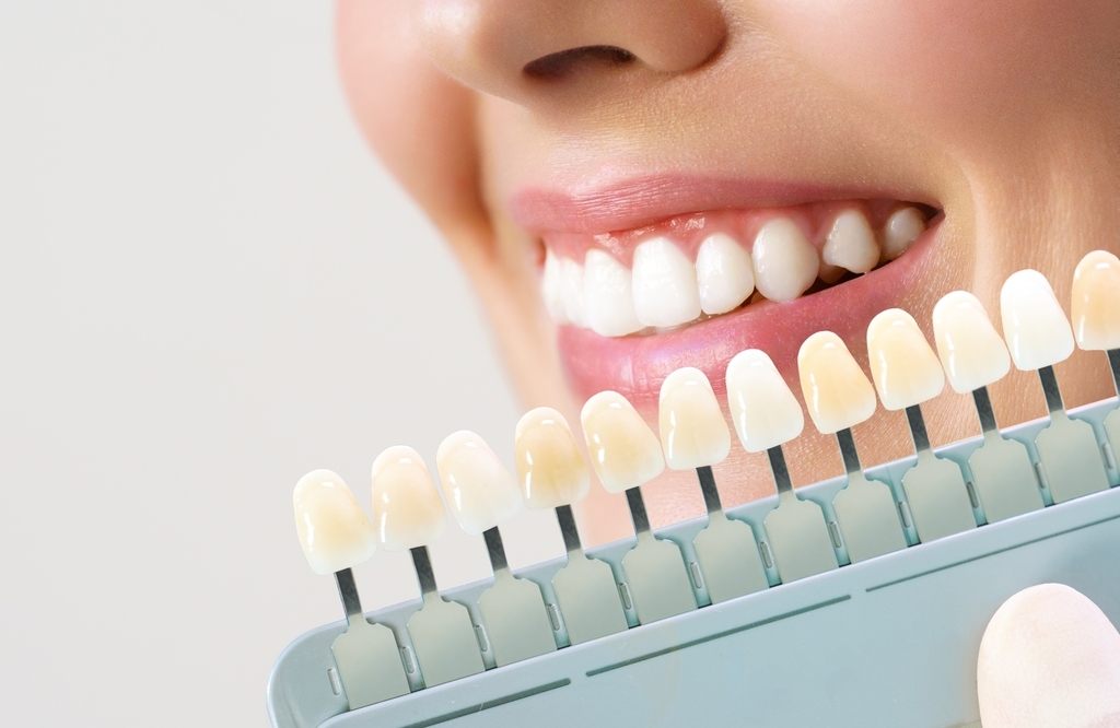 Zahnaufhellungskarte im vergleich zu den Zähnen