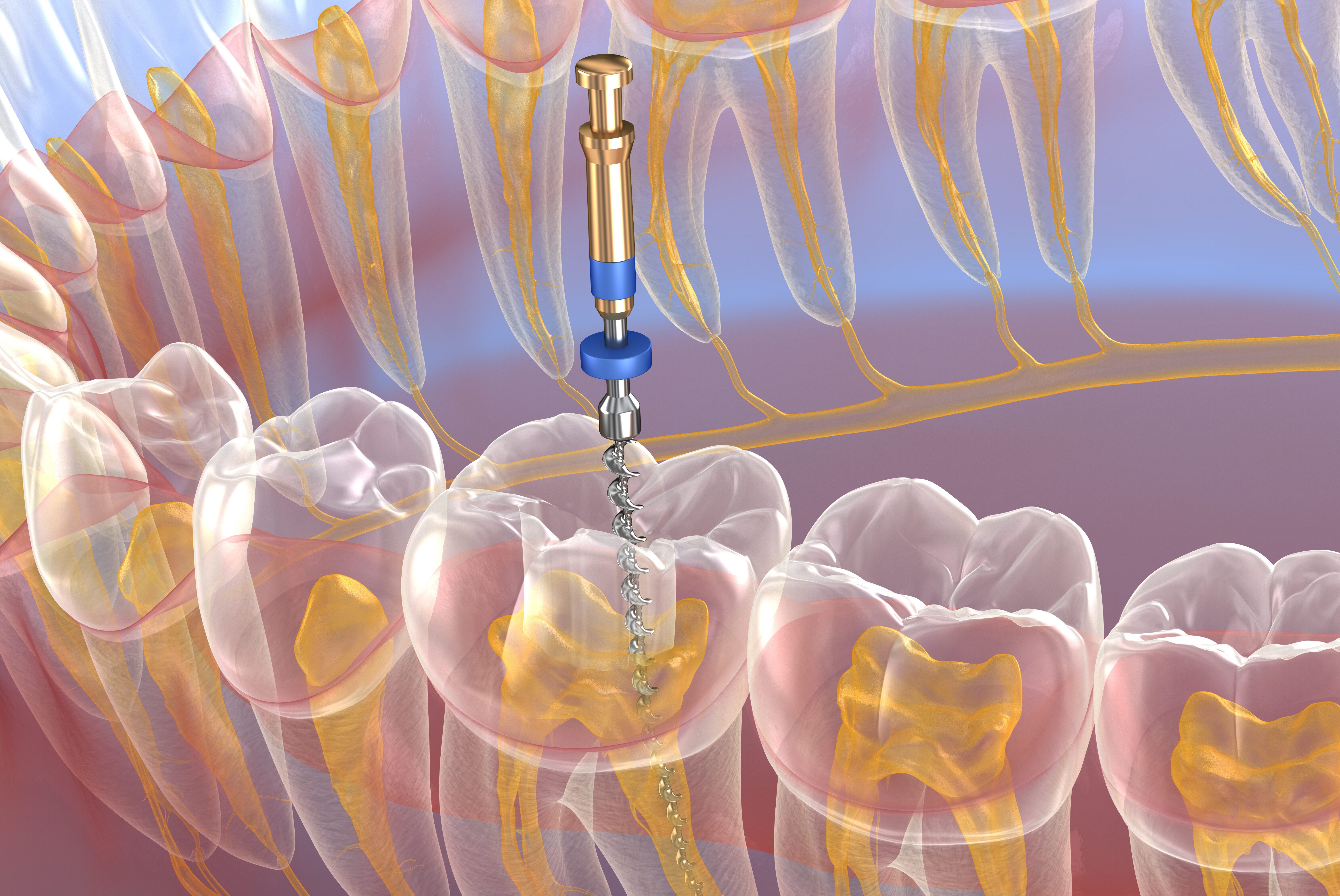 Wurzelkanalbehandlung