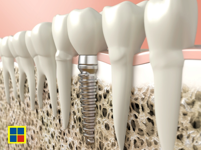 Knochenaufbau bietet Zahnimplantaten ein stabiles Fundament - Aktuelles  Item - Dr. Fichna & Partner | Zahnrzte und Oralchirurgie in Ansbach