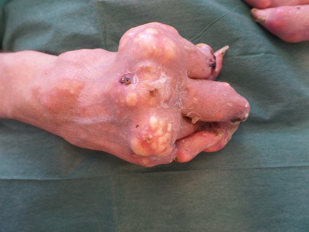 Ein Bild einer Hand mit fortgeschrittenerGichtathritis
