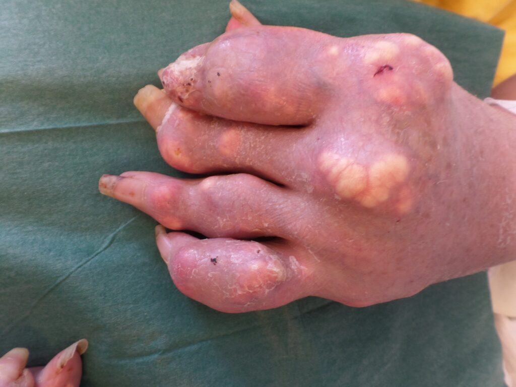 Ein Bild einer Hand mit fortgeschrittenerGichtathritis