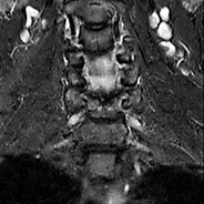 Lendenwirbelsäule – Frontalschnitt (koronale Ansicht)