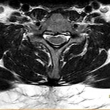 Lendenwirbelsäule – Axialschnitt