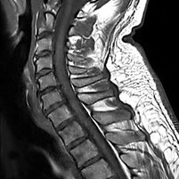 Halswirbelsäule – Sagittalschnitt (T2-gewichtet)