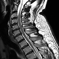 Halswirbelsäule – Sagittalschnitt (T1-gewichtet)