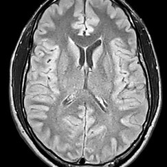 Gehirn – Axialschnitt, T2-gewichtete MRT