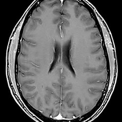 Gehirn – Axialschnitt, T1-gewichtete MRT