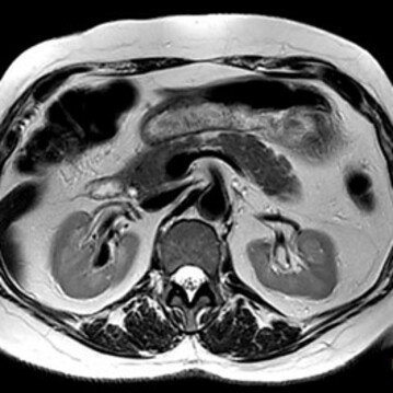 Oberbauch-MRT – Axialschnitt, T2-gewichtet (MRCP-fähig)