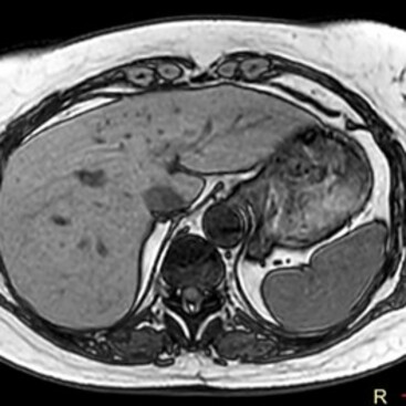 Oberbauch-MRT – Axialschnitt, T1-gewichtet