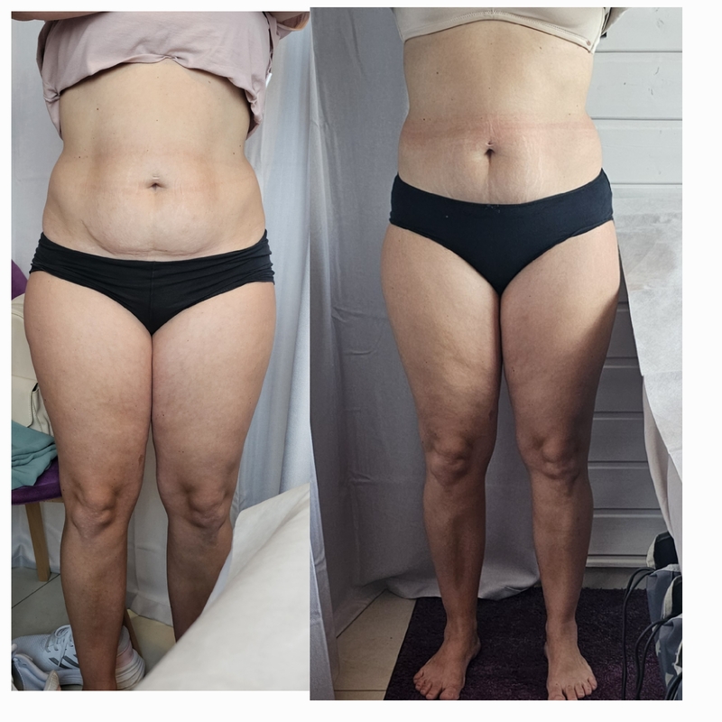 Anti-Cellulite Behandlung
