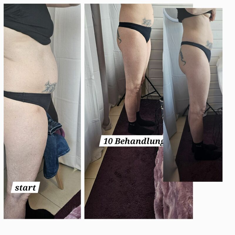 Fettzellen Ultraschall öffnen
