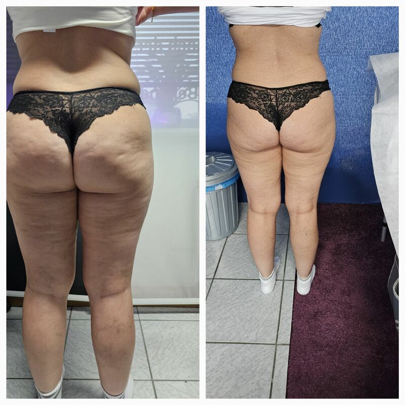 Hautstraffung und Muskelaufbau
