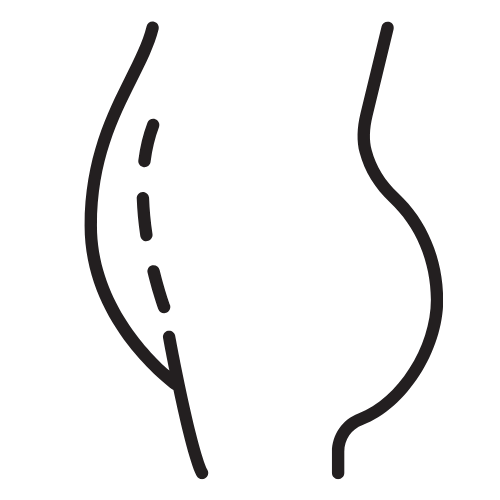 Bauchfett entfernen mit Kryolipolyse