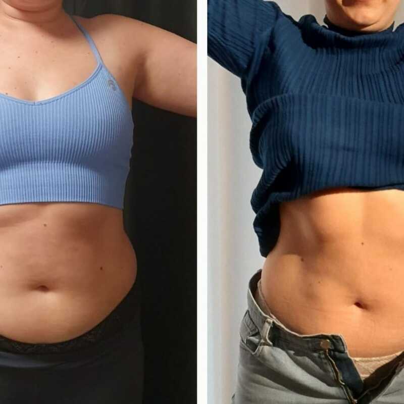 Bauchfett Entfernung - Kryolipolyse