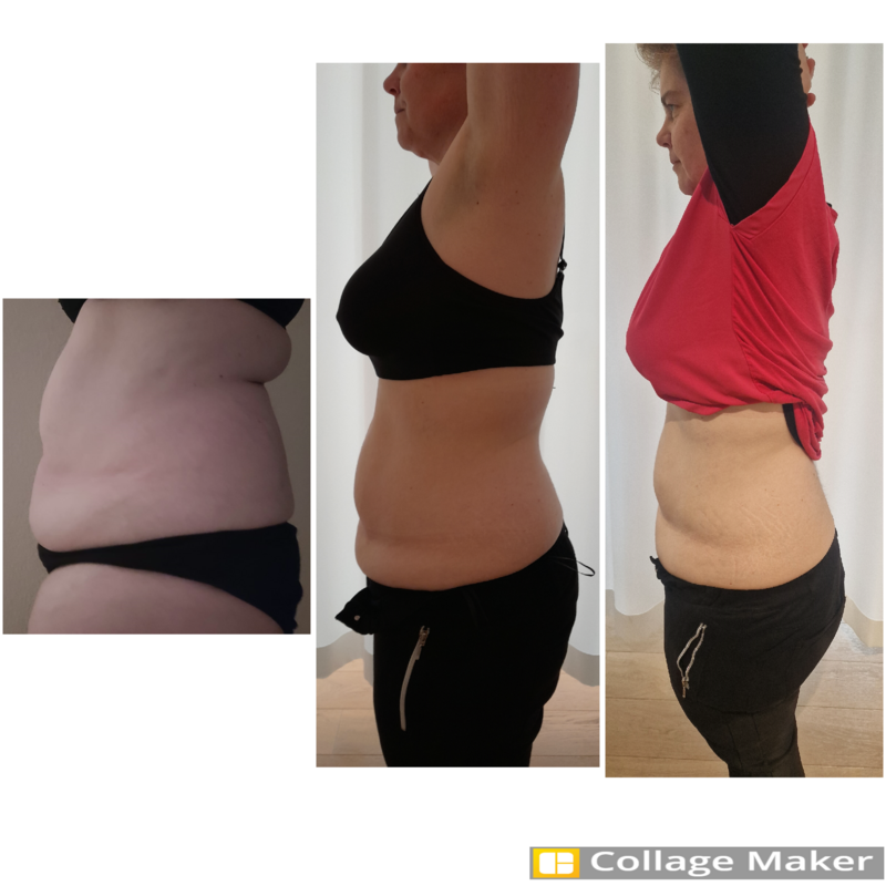 Bauchumfang Verkleinerung. - Kryolipolyse