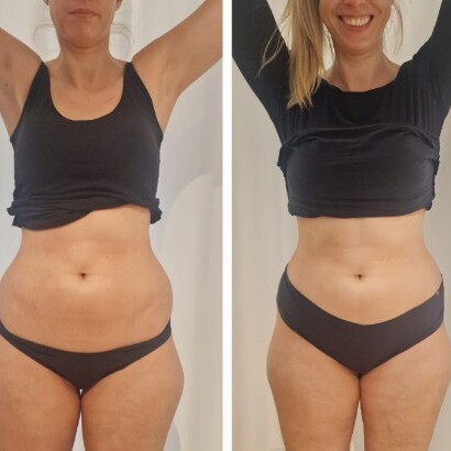 Bauchfett - Kryolipolyse Vorher Nachher