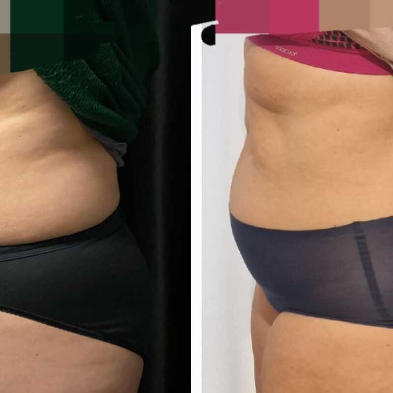 Hüftgold - Kryolipolyse Vorher Nachher